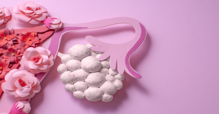 A’dan Z’ye Yumurtalık Kisti